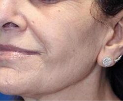 Secret RF Before & After Patient #1619